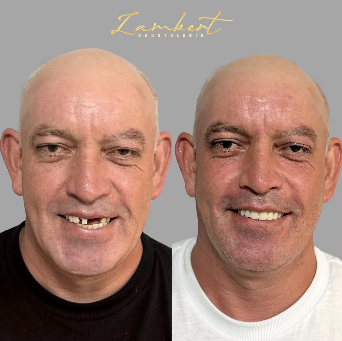 Clareamento Dental